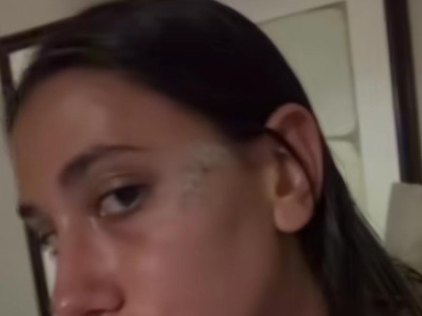 “Salí a bailar y volví con ocho puntos en la cara”: joven argentina denuncia haber sido golpeada en un baile de Piriápolis