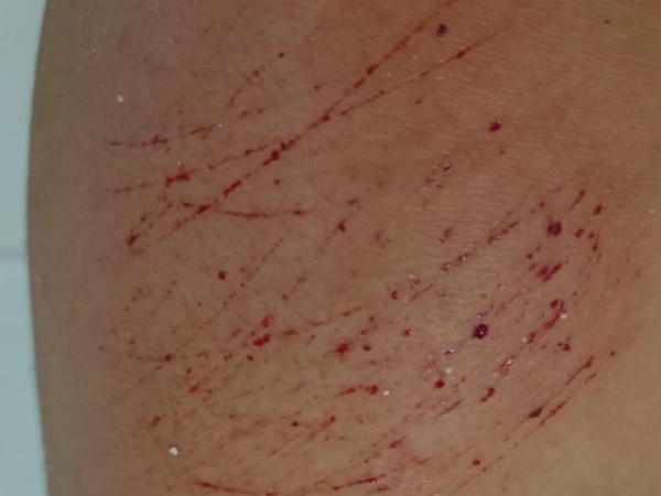 Mujer denuncia ataque de perros en barrio Hipódromo: “A los dueños no les importa”