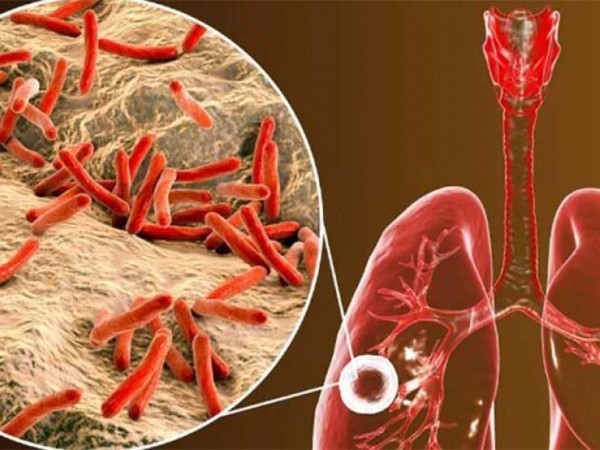 tuberculosis, enfermedad, Maldonado, Uruguay