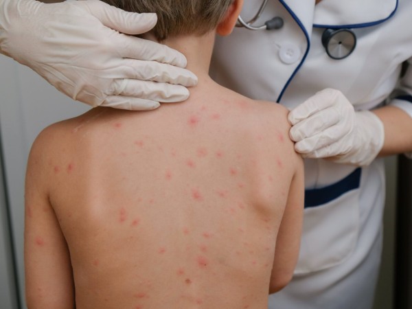 Ministra de Salud alerta por avance de sarampión y anuncia jornada nacional de vacunación
