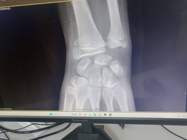 Una niña fue operada tras sufrir una doble fractura en una escuela de Maldonado: la madre cuestionó la atención recibida por el centro educativo
